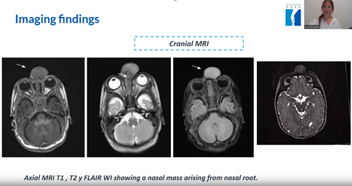 INTRA AND EXTRA-NASAL GLIAL HETEROTOPIA IN A NEWBORN WITH CONGENITAL NASAL TUMOR
